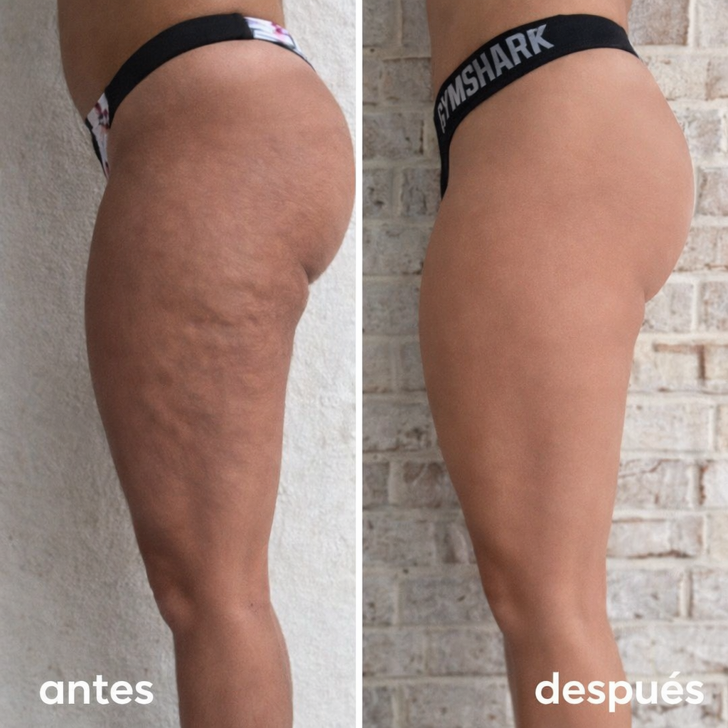 ROLLERLIVIA™ 🌸 Rodillo de Drenaje y Alivio para Piernas Cansadas